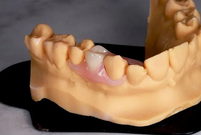 Prótesis dental flexible en El Salvador: precio, Valplast y cuidados