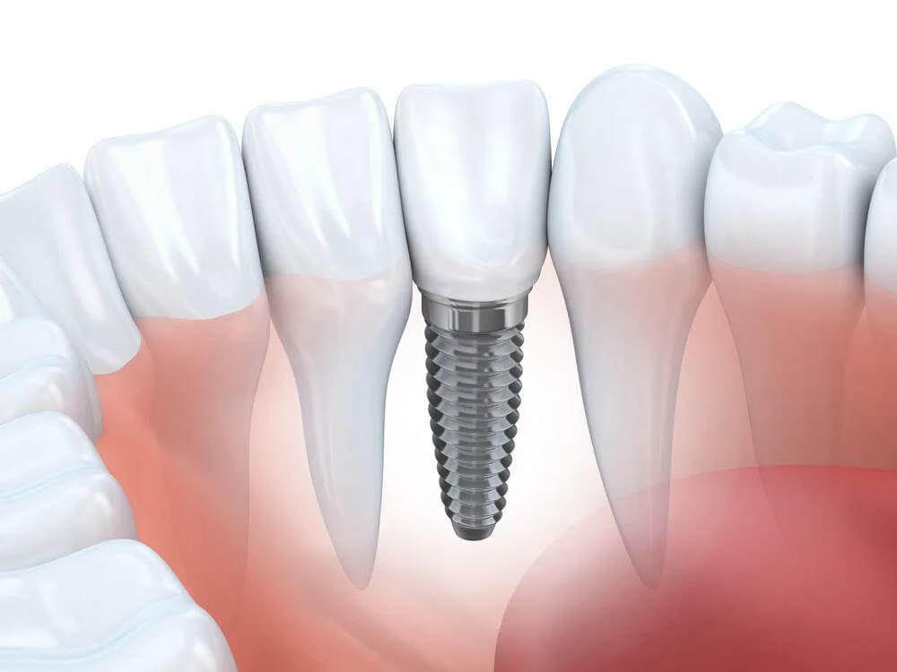 Costo de los implantes dentales en El Salvador