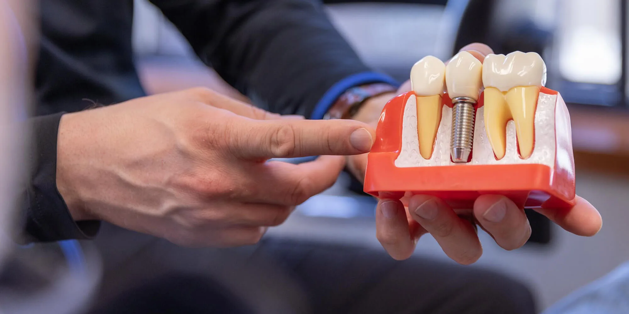10 preguntas y respuestas sobre los implantes dentales