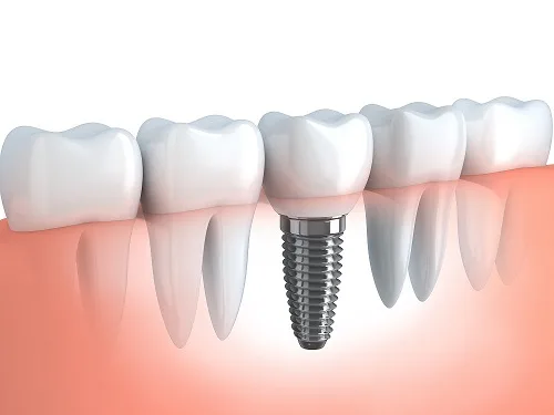 Precio y costo de los implantes dentales en El Salvador 2020