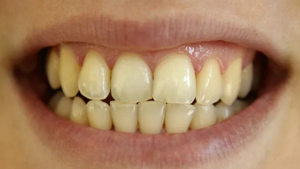 Dientes amarillos