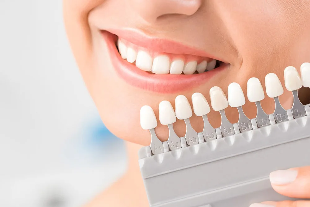 ¿Qué tipo de blanqueamiento dental es mejor para mí?