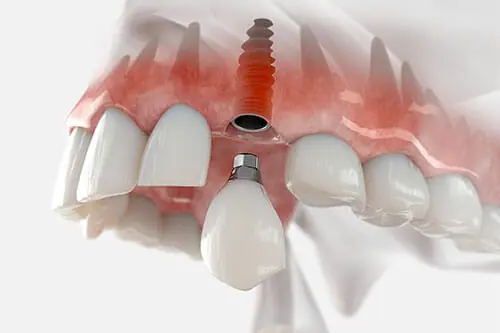 Clínicas de Implantes Dentales en El Salvador
