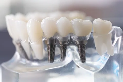 Candidatos a Implantes Dentales en El Salvador