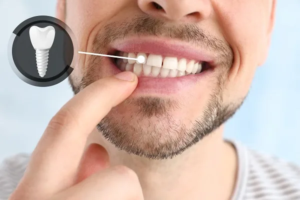 Candidatos a Implantes Dentales en El Salvador