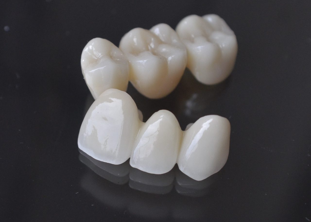Capsule Denti In Porcellana Ceramica E Zirconio Clinica A Durazzo Dential Il Dentista In Albania - Foto 5