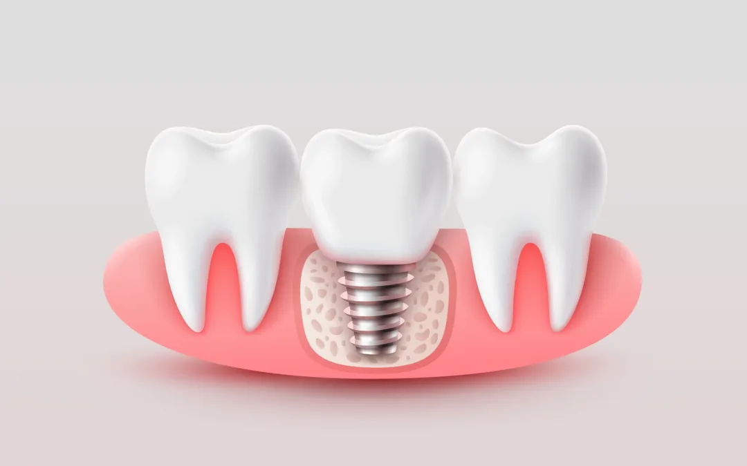 implantólogia Dr. Carlos Santos en Colonia Escalón, San Salvador